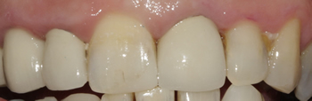 After picture of white filling buildup in a patient from Uxbridge at our Ickenham dentist