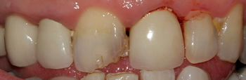 Before picture of white filling buildup in a patient from Uxbridge at our Ickenham dentist