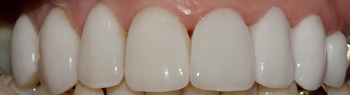 After picture of veneers teeth in a patient from Ickenham at our dentist in Uxbridge